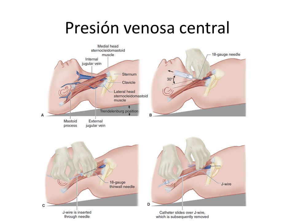 Medición de la presión venosa arterial Medición de la presión venosa arterial